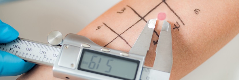 化妝品皮膚變態(tài)反應(yīng)試驗